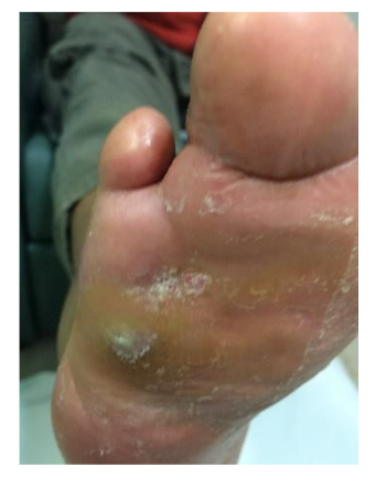 Foot ulcer healing was achieved in 8 weeks.