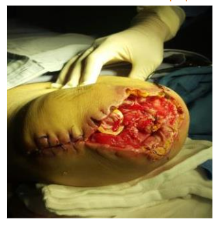 Male patient, 68 y. o., DM2, treated elsewhere for diabetic foot, very complicated, 3 previous amputations failed.