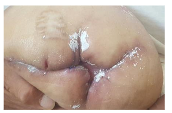 Rx. healing occurred 28 days after treatment with CPZO.