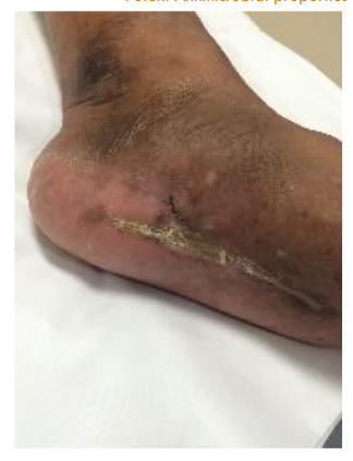 Male patient treated elsewhere initially, 56 y.o., DM2.