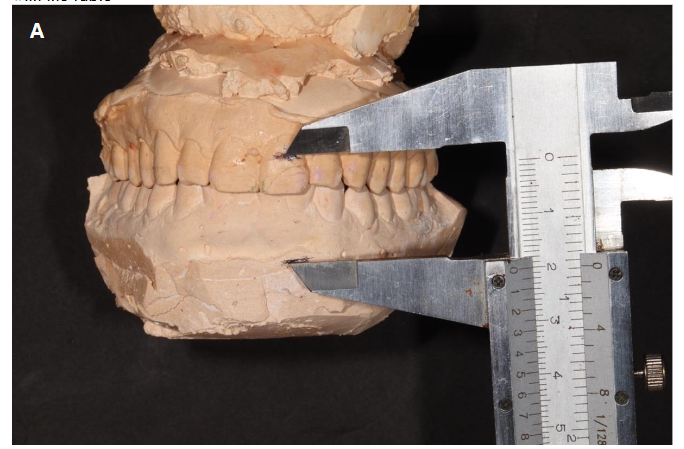 Note: A. measured without the occlusal splint. B. measured with the occlusal splint