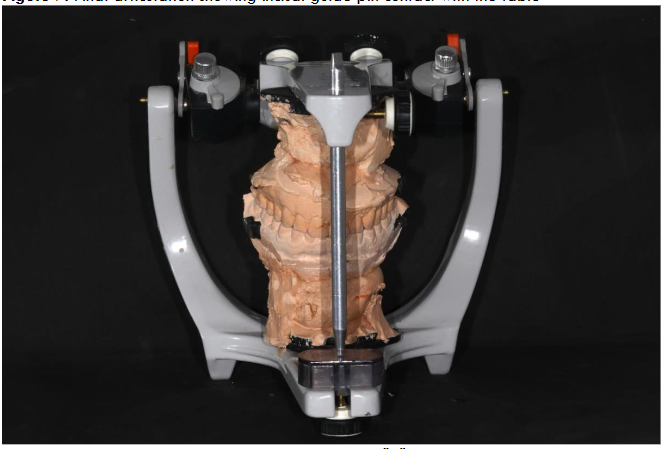 Note: Articulated models with the incisal pin in the "0" position enable occlusal analysis in the neuromuscular balance position.
