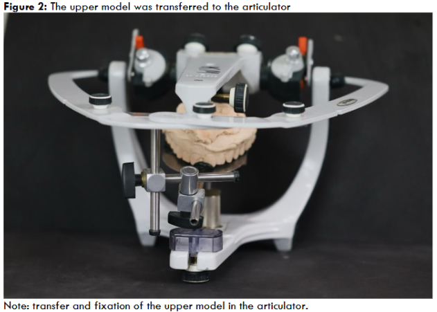 Figure 2: The upper model was transferred to the articulator Note: transfer and fixation of the upper model in the articulator. Source: author’s own