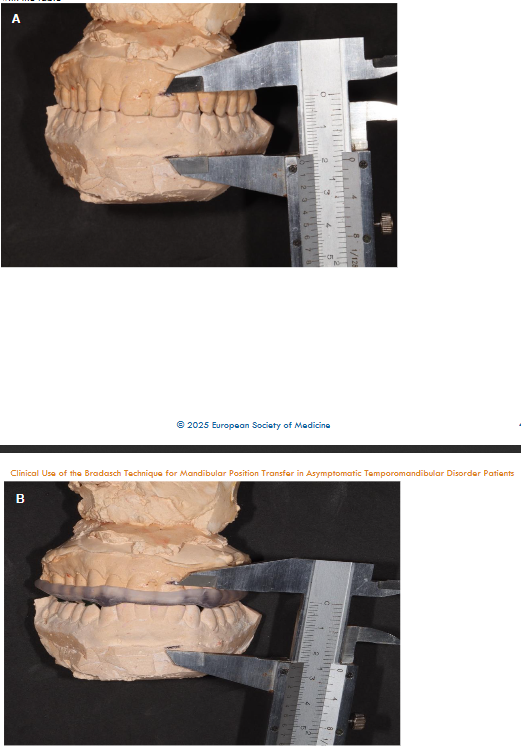 Figure 4: Interincisal distance measurements with and without splint. Final articulation showing incisal guide pin contact with the table Note: A. measured without the occlusal splint. B. measured with the occlusal splint Source: author’s own