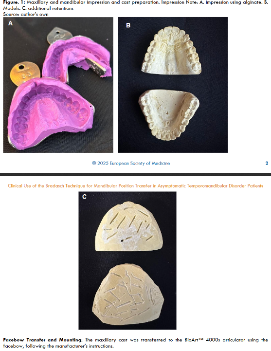 Figure 1: Maxillary and mandibular impression and cast preparation. Impression Note: A. impression using alginate. B. Models. C. additional retentions Source: author’s own