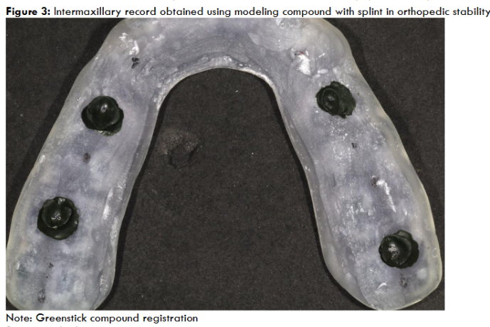 Figure 3: Intermaxillary record obtained using modeling compound with splint in orthopedic stability Note: Greenstick compound registration Source: author’s own