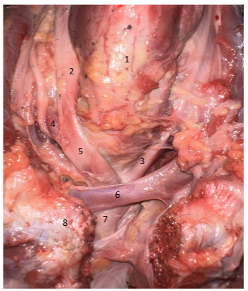 Image - Left Brachiocephalic vein and Brachiocephalic artery in a cadaver