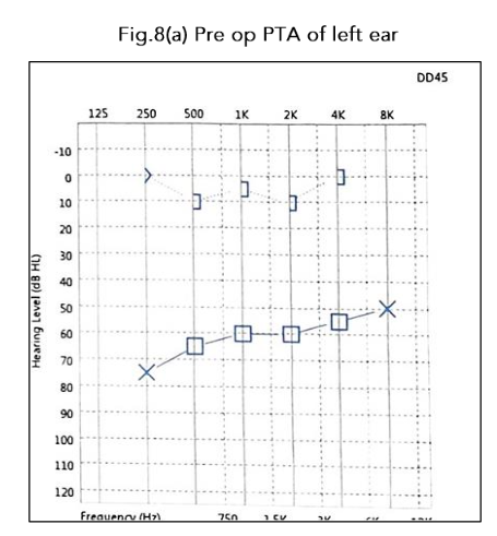 Fig. 8(a) Pre op PTA of left ear