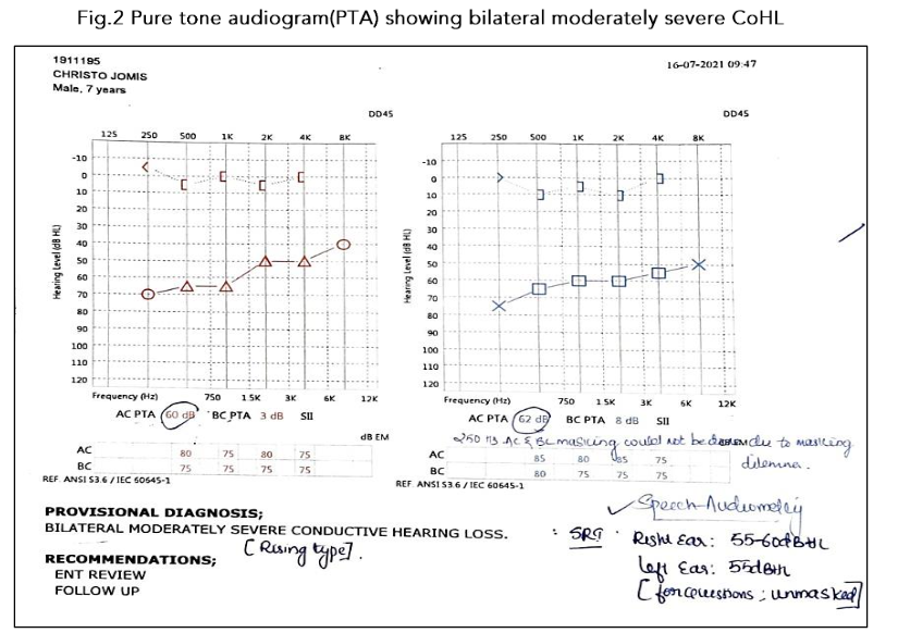 Fig. 2 Pure tone audiogram(PTA) showing bilateral moderately severe CoHL