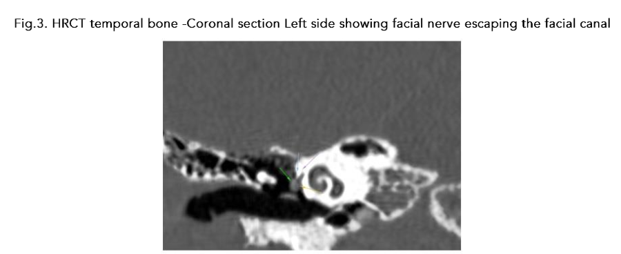Fig. 4. HRCT temporal bone-left side section showing facial nerve escaping through facial canal and coursing the promontory, through the deformed stapes