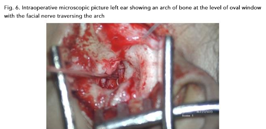 Fig. 6. Intraoperative microscopic picture left ear showing an arch of bone at the level of oval window with the facial nerve traversing the arch