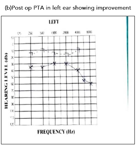 Fig. 8(b) Post op PTA in left ear showing improvement