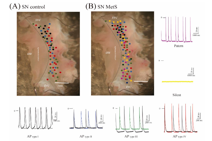 Figure 3. The electrical activity analysis. (A) Sinus Node control mapping. (B) Sinus node MetS mapping with two new AP. The control activity or Action Potentials AP type I shows changes in 60 and 90% of AP by obesity and insulin resistance.