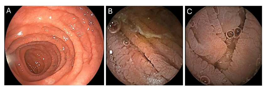 Figure 1. Endoscopic markers of villous atrophy in celiac disease. Esophagogastroduodenoscopy (A) and video capsule endoscopy (B, C) images of duodenal scalloping and fissuring in patients with new diagnosis of celiac disease.