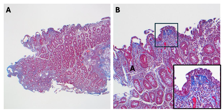 Figure 2. Histological features of collagenous sprue. Collagenous duodenitis with duodenal villous blunting (A, 4x and B, 20x), chronic active duodenitis, intraepithelial lymphocytosis and subepithelial collagen band (trichrome stain, inset B, 40x).