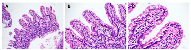 Figure 3. Duodenal biopsy from the same patient as Figure 2 demonstrating histologic resolution of collagenous sprue following strict gluten-free diet. (A) 10x H&E stain: Low-power view showing largely maintained villi to crypt ratio, with no obvious villous blunting and shortening. (B) 20X H&E stain: Villi with minimal intra-epithelial lymphocytosis. (C) 40x H&E stain: High-power view of unremarkable duodenal villi, consistent with treatment response. H&E = hematoxylin and eosin stain.