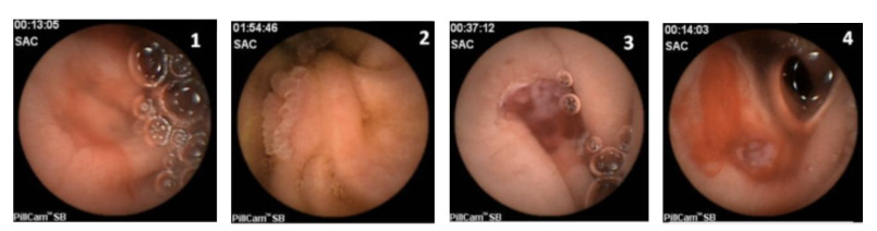 Figure 4. Video capsule endoscopy findings in ulcerative jejunitis. (1) Duodenal fold scalloping, (2) elevated mucosal lesion with broad villi, (3, 4) ulcerative jejunitis. Image and legend adapted from Sigman et al., 2014, BMC Gastroenterology, 14:29. Distributed under CC BY 2.0. Image cropped; legend condensed.