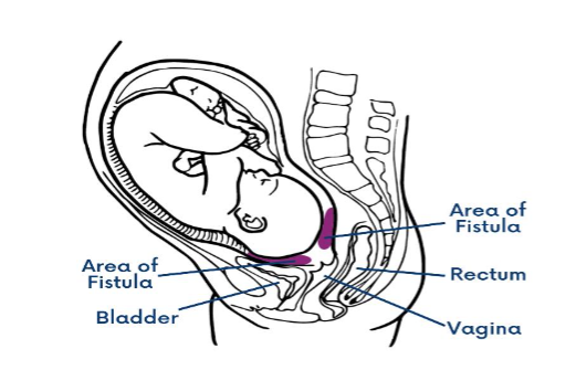 Figure 1: Development of Fistula During Obstructed Labour