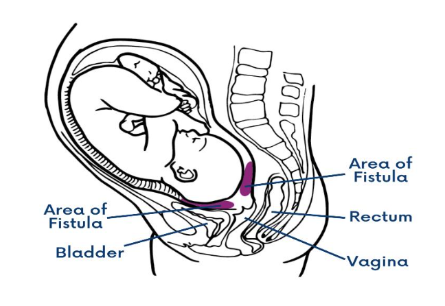 Figure 1: Development of Fistula During Obstructed Labour