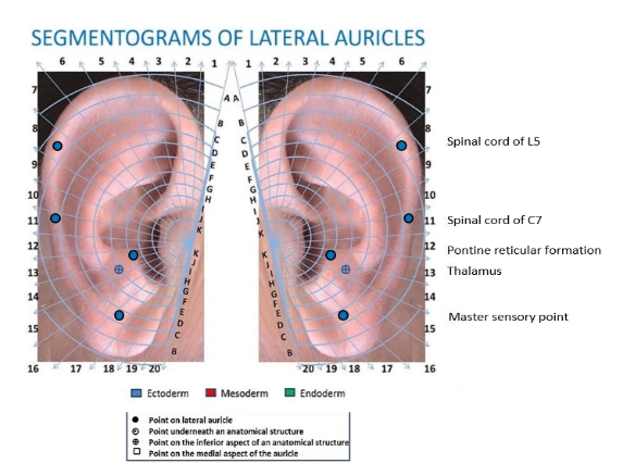 Auriculotherapy used for all patients: 1) Spinal cord of L5, 2) Spinal cord of C7, 3) Pontine reticular formation 4) Thalamus 5) Master sensory point