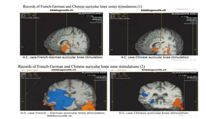 Evidence of therapeutic action of cryogenic needles. In D. Alimi, A. Geissmann, D. Keeper, and F. Bahr’s Study in fMRI of the stimulation of the auricular area of the knee. The Journal of Radiology Photon 2014; 125:133-141