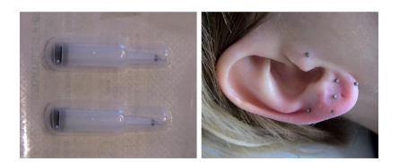 Semi-Permanent Needles: Disposable sterile needles, made of nickel-free stainless steel, 2 mm in length and 0.7 mm in diameter, only used in Auriculotherapy.