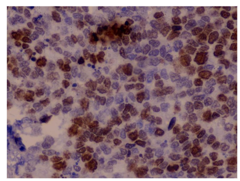 Figure 2: Representative immunohistochemical staining for Ki-67 expression in cervical intraepithelial neoplasia (CIN) lesions.