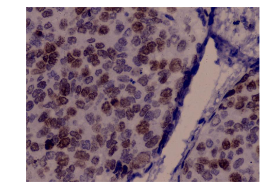 Figure 4: Representative immunohistochemical staining for p53 expression in cervical intraepithelial neoplasia (CIN) lesions.