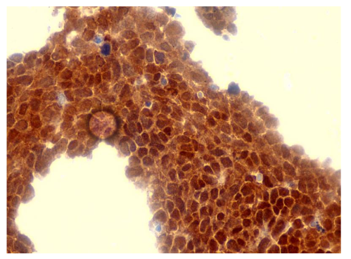 Figure 6: Representative immunohistochemical staining for p16 expression in cervical intraepithelial neoplasia (CIN) lesions.