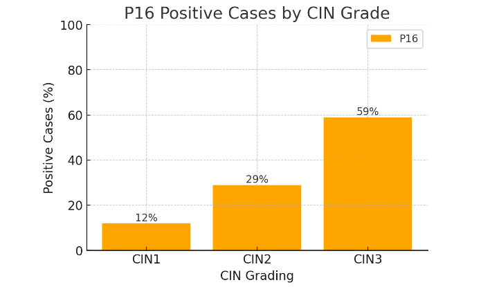 Figure 5: Bar chart showing the percentage of P16 positive cases across different CIN grades (CIN1, CIN2, CIN3). P16 expression compared in patients with CIN1 vs CIN2 and CIN2 vs CIN3. p<0.0001 in both cases.