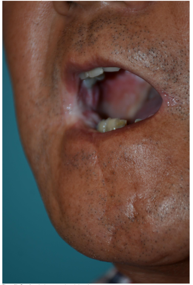Transferred colon tissue in the right buccal area.
