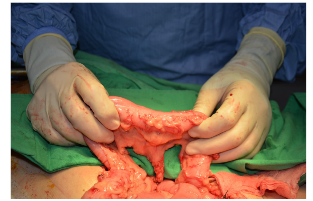 A segment of ascending colon flap based on the right colic artery.
