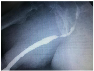 Figure 2: Urethral stricture due to insufficient lubrication of the catheter and urethra at the start of insertion.