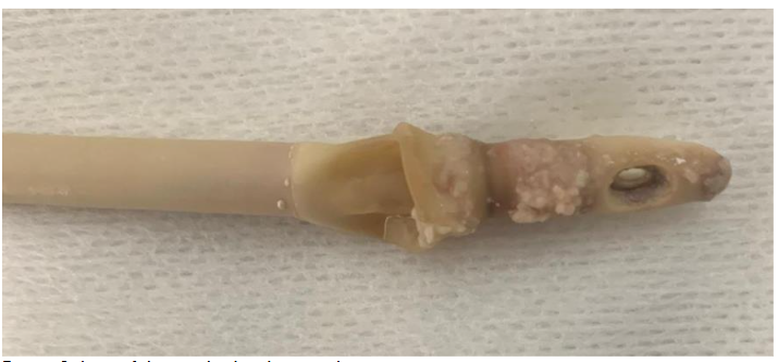Figure 3: Latex foley urethral catheter with incrustations.