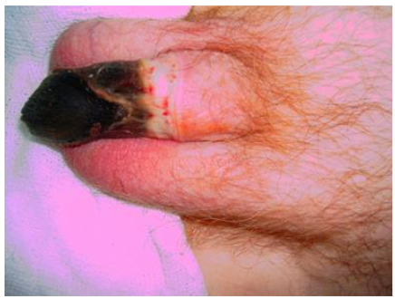 Figure 4: Penile necrosis caused by the prolonged constrictor effect of the adhesive binding band of the condom catheter.