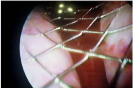 Figure 5: Permanent prostatic stent inserted into the male urethra.