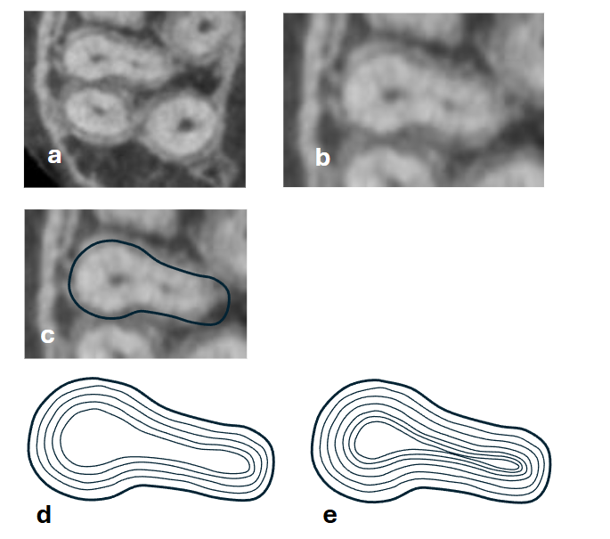 Figure 1. Development of two root canals in a MB root of a maxillary molar. (a) Axial view of a CBCT scan of a maxillary molar. (b) The oval root magnified. (c) The outline of the oval root where the root development began. (d) Early stages of root development: a wide oval canal. (e) Continuous dentin apposition results in two distinct canals: MB1 and MB2.