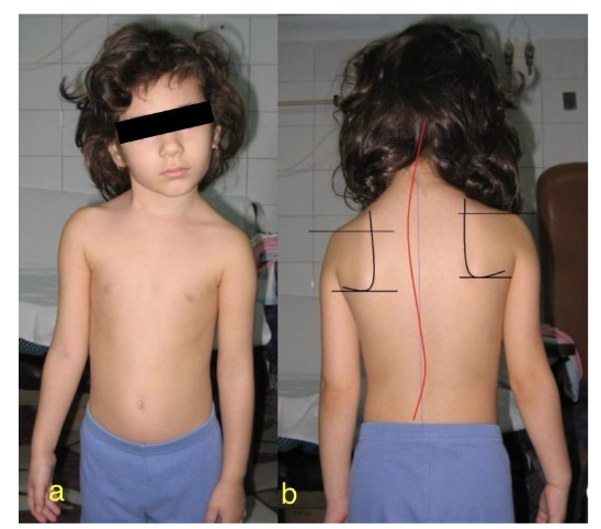 Fig.2. A 12-year-old teenager with CMT. a) pathognomonic configuration of the cephalic extremity b) double cervico-thoraco-lumbar scoliosis induced by the presence of CMT.