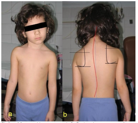 Fig.2. A 12-year-old teenager with CMT. a) pathognomonic configuration of the cephalic extremity b) double cervico-thoraco-lumbar scoliosis induced by the presence of CMT