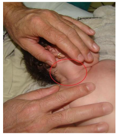 Fig.1 Two-month-old patient diagnosed at birth with congenital muscular torticollis. The relief of the sternocleidomastoid muscle and the prominent sternocleidomastoid pseudotumor can be noticed.