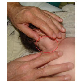 Fig.1 Two-month-old patient diagnosed at birth with congenital muscular torticollis. The relief of the sternocleidomastoid muscle and the prominent sternocleidomastoid pseudotumor can be noticed.