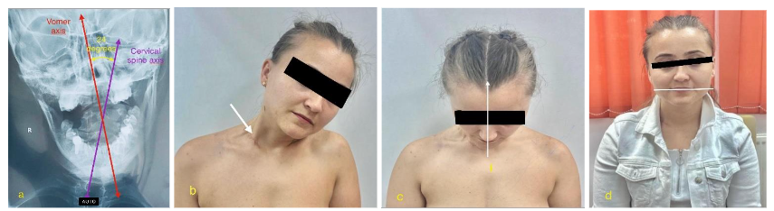 Fig.4 A 26-year-old female patient who underwent a surgical intervention using the RSPO technique. a) Dextroconcave cervical scoliosis tilts the cephalic axis at 24 degrees. b) Sectioning the distal insertions of the SCM muscle and detaching the muscle belly reveals ⅔ of the muscle belly relief and a limited but considerable lateral movement of the cervical spine. c) Facial asymmetry, more pronounced when the head is flexed, remains a stigma for all patients with torticollis who undergo surgery at school age or as adults. d) Two years postoperatively, the line of the mouth corners is horizontal, but the line of the eyelid slits remains oblique.