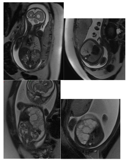 Fig. 3a and 3b-. Fetal MRI, HASTE T2-weighted sequence, coronal images. Lung sequestration. Large, well-circumscribed, hyperintense signal mass in the left hemithorax, with a vessel originating from the descending thoracic aorta and venous drainage vessels leading toward the pulmonary hilum.