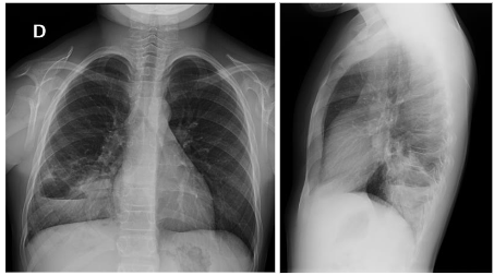 Figure 1. Consolidation in the right lung base with cavitation.