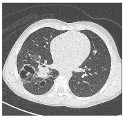 Figure 2. Congenital pulmonary malformations with large and small cystic areas of hyperinflation. No systemic irrigation was observed.