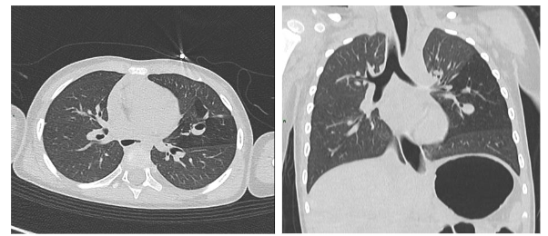 Figure 4. Bronchial atresia. The inferior lingular bronchus shows focal dilation with the presence of an air-fluid level. Distally, the parenchyma appears hyperinflated, with smaller vascular structures.