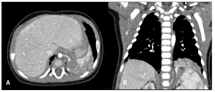 Figure 5. Computed tomography in axial and coronal reconstruction shows a solid mass in the left lung base with an arterial vessel arising from the systemic circulation.
