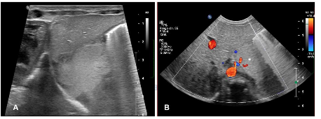 Figure 6. Intra-abdominal extralobar pulmonary sequestration. In (A) Echogenic homogeneous mass in the left flank, with an afferent vessel originating from the abdominal aorta.