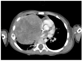 Figure 7. Axial section of computed tomography with intravenous contrast in the venous phase. A large solid mass is observed in the right hemithorax, displacing mediastinal structures to the left and showing heterogeneous enhancement, with no evidence of calcifications or cavitation.