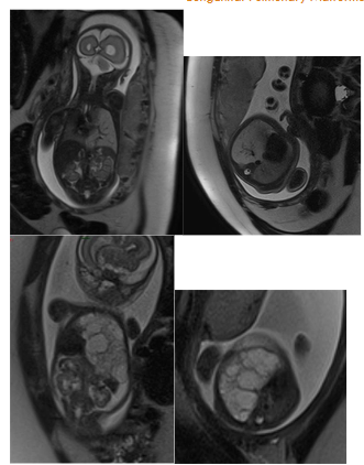 Figure 3a and 3b. Lung sequestration. Large, well-circumscribed, hyperintense signal mass in the left hemithorax, with a vessel originating from the descending thoracic aorta and venous drainage vessels leading toward the pulmonary hilum.